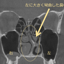 鼻中隔弯曲症に対する鼻中隔矯正術 -日帰りで行う鼻づまりを改善させる手術①-