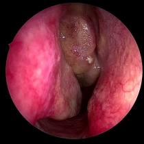 手術後に再発した鼻茸を伴う慢性副鼻腔炎に対する注射による治療